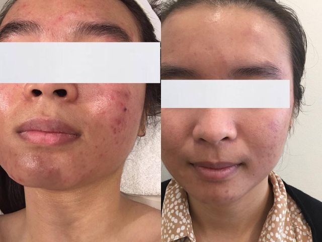 Dermalux™ LED phototherapy