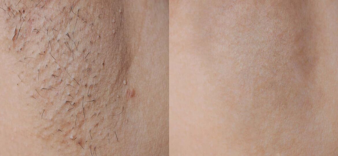 laser-before-after-armpit