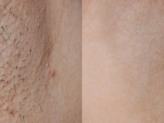 laser-before-after-armpit