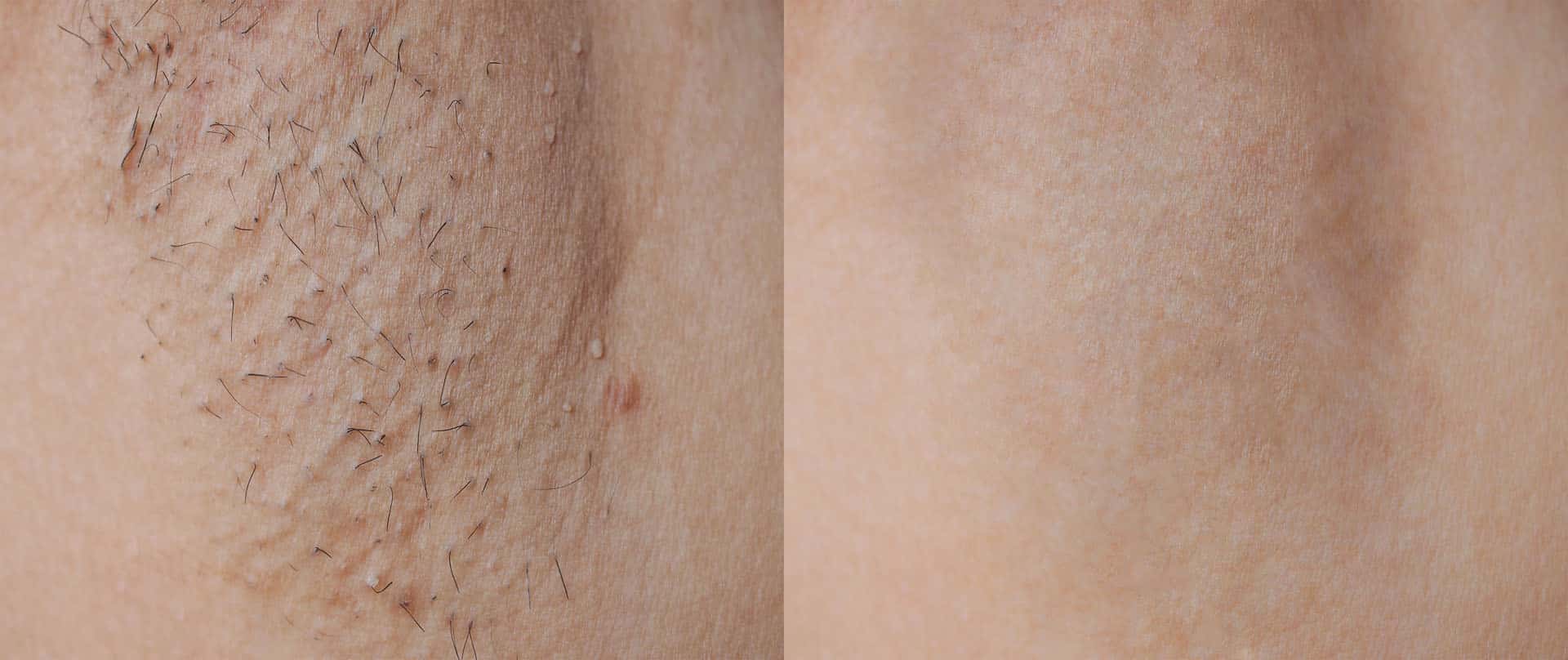 Laser hair removal