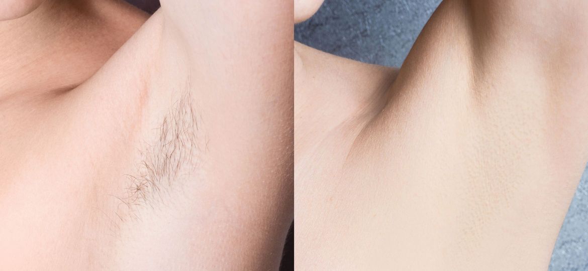 Laser hair removal v/s IPL