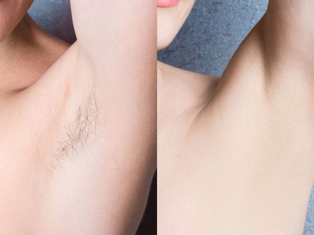 Laser hair removal v/s IPL