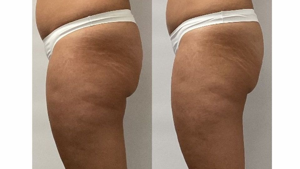 LPG Endermologie Cellu M6