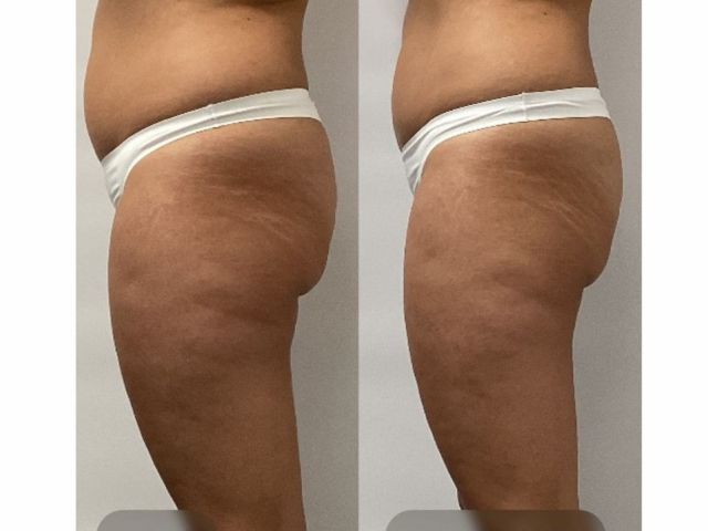 LPG Endermologie Cellu M6
