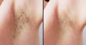 Skin after waxing treatment results