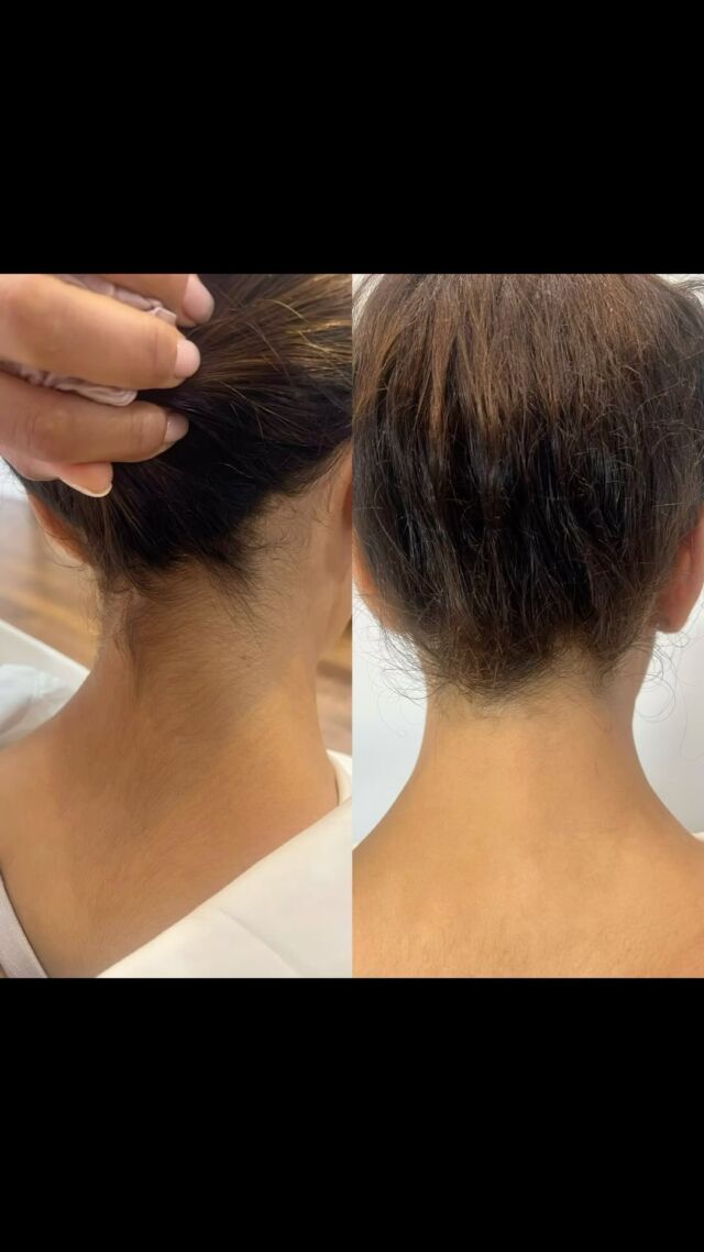 After just 1 Session of Laser Hair Removal with us a reduction of 30% off less hair and smoother feeling skin.
We are offering New clients 50% off the first session to try us out ! 
Underarms £29.50
Full Bikini £49.50
Upper lip £29.50
Full Face 68.50
Full Legs & Feet £99.50
•
.
.
#alexandritelaserlondon #candela #laser #smoothskin #laserhairremoval #salon #laserlondon #chancerylane #healthyskin #laserbody #hairremoval #alexandrite
